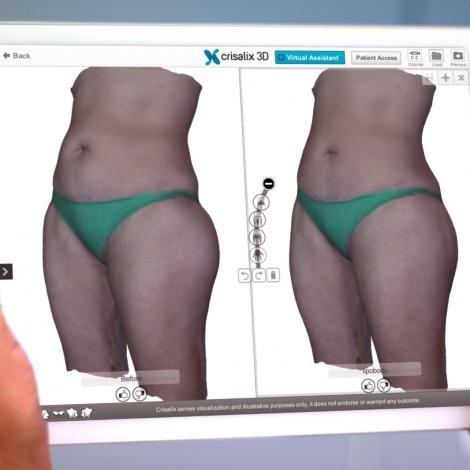 Crisalix VR 3D & 4D phần mềm mô phỏng giả lập trong phẫu thuật thẩm mỹ