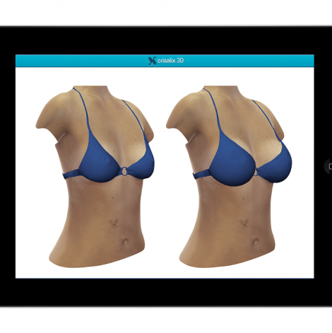 Crisalix VR 3D & 4D phần mềm mô phỏng giả lập trong phẫu thuật thẩm mỹ