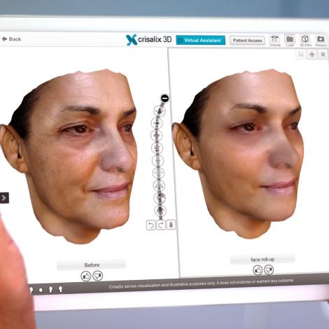 Crisalix VR 3D & 4D phần mềm mô phỏng giả lập trong phẫu thuật thẩm mỹ