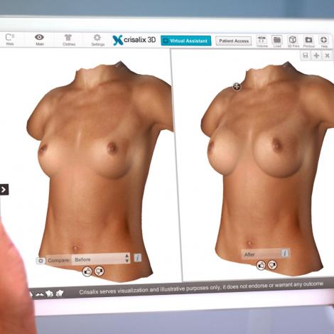 Crisalix VR 3D & 4D phần mềm mô phỏng giả lập trong phẫu thuật thẩm mỹ